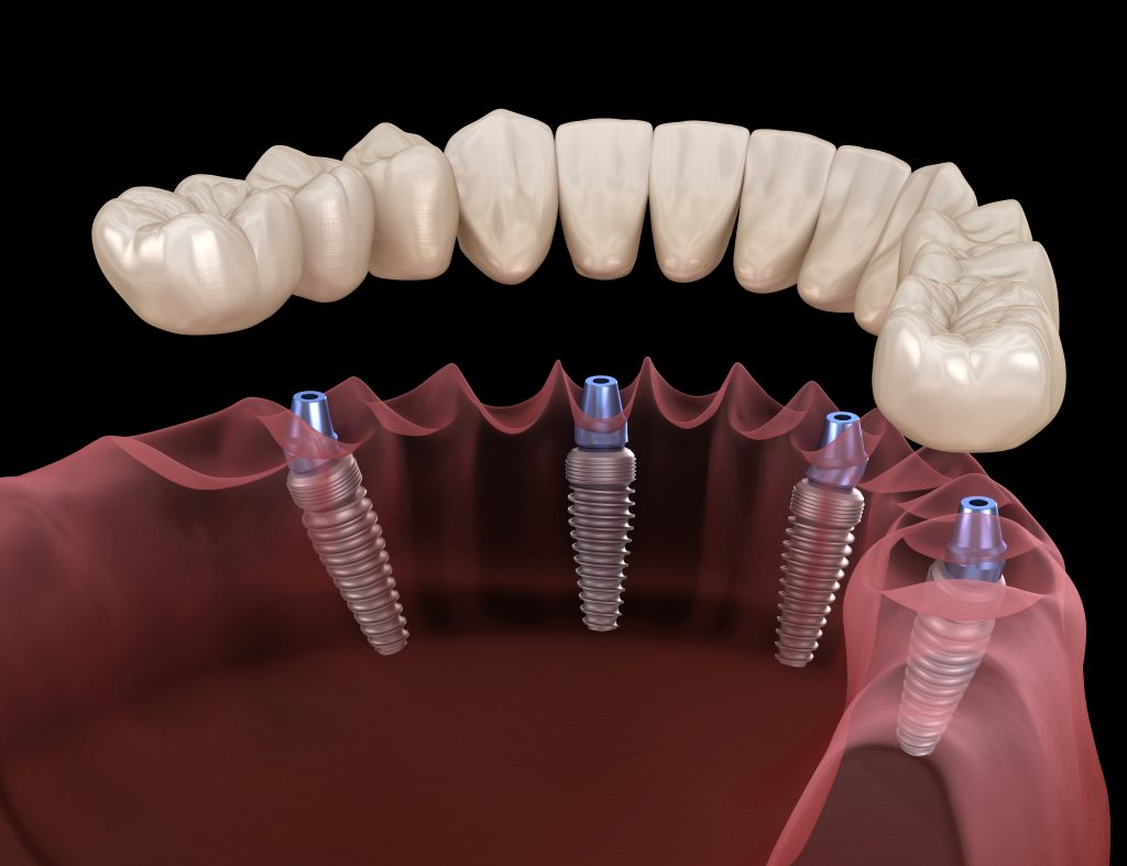 dental implants ventura