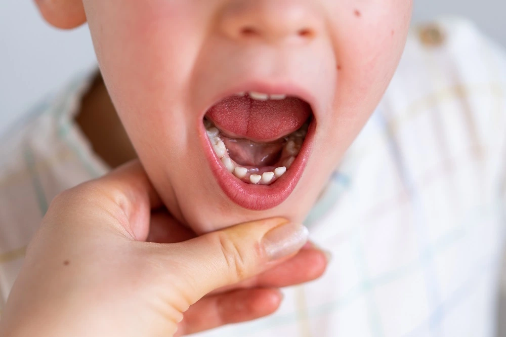 WHAT TO DO WHEN YOUR CHILD LOSES A TOOTH?