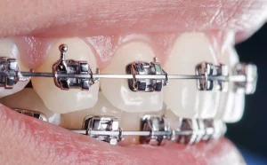 close-up-dental-braces-on-teeth-orthodontic-treat