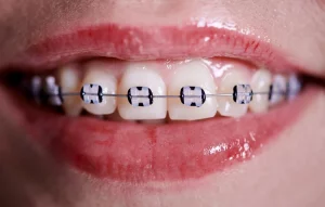macro-snapshot-of-white-teeth-and-ceramic-braces