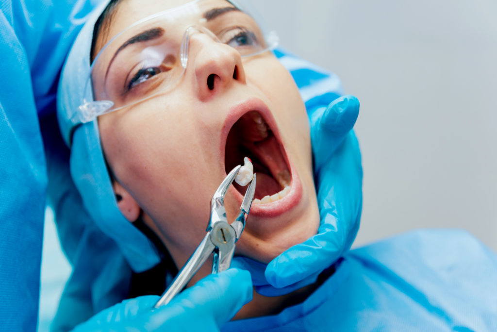 Types of Dental Extractions