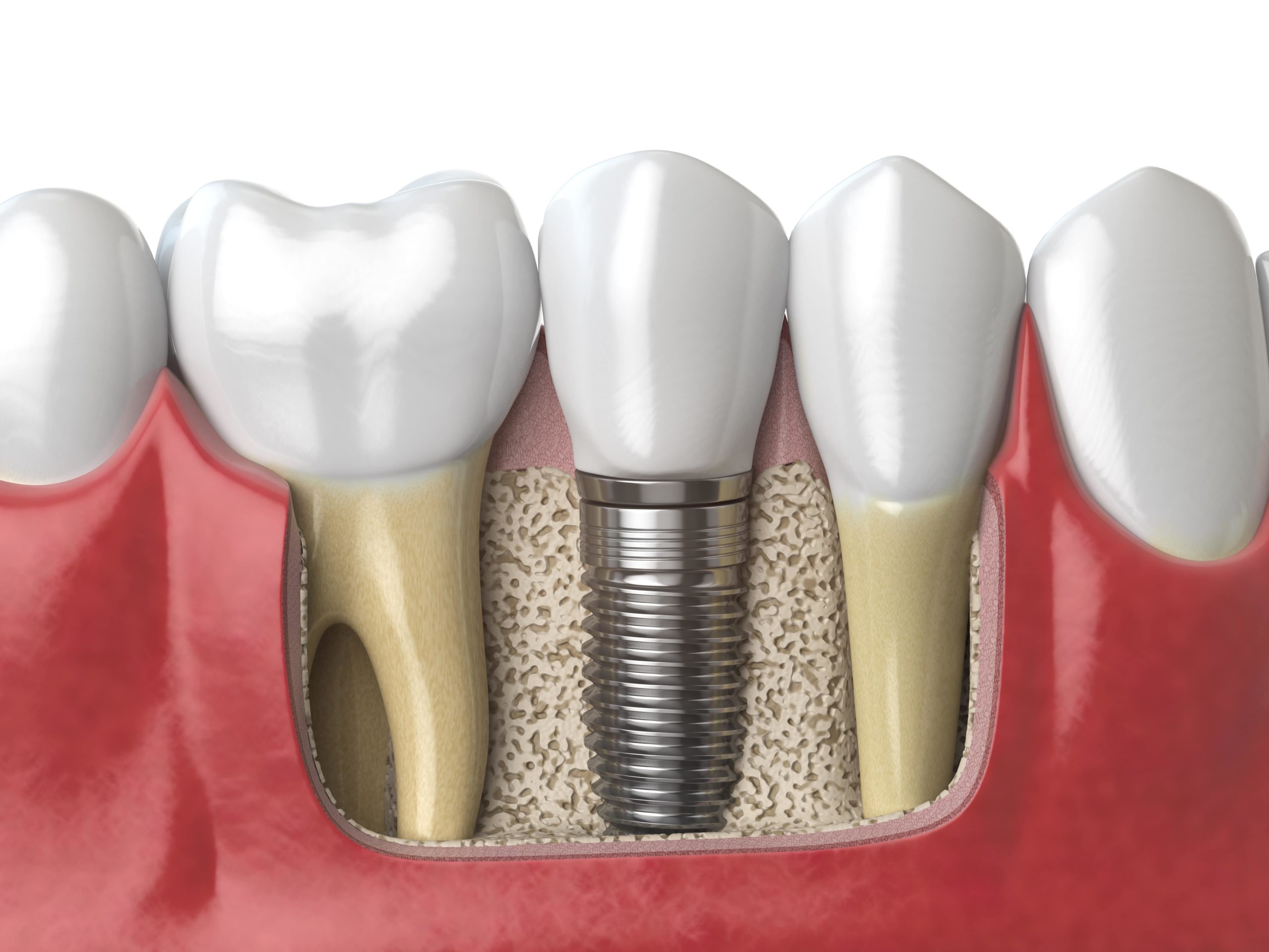The best dental implants in