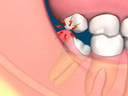 Pericoronitis - Channel Islands Family Dental Office | Dentist In Ventura County