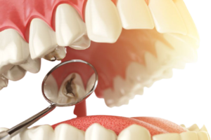 root canal dental services
