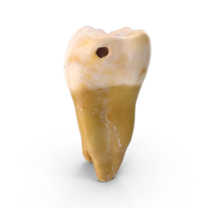 will cavities go away