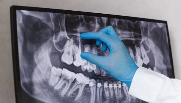 root canal infection