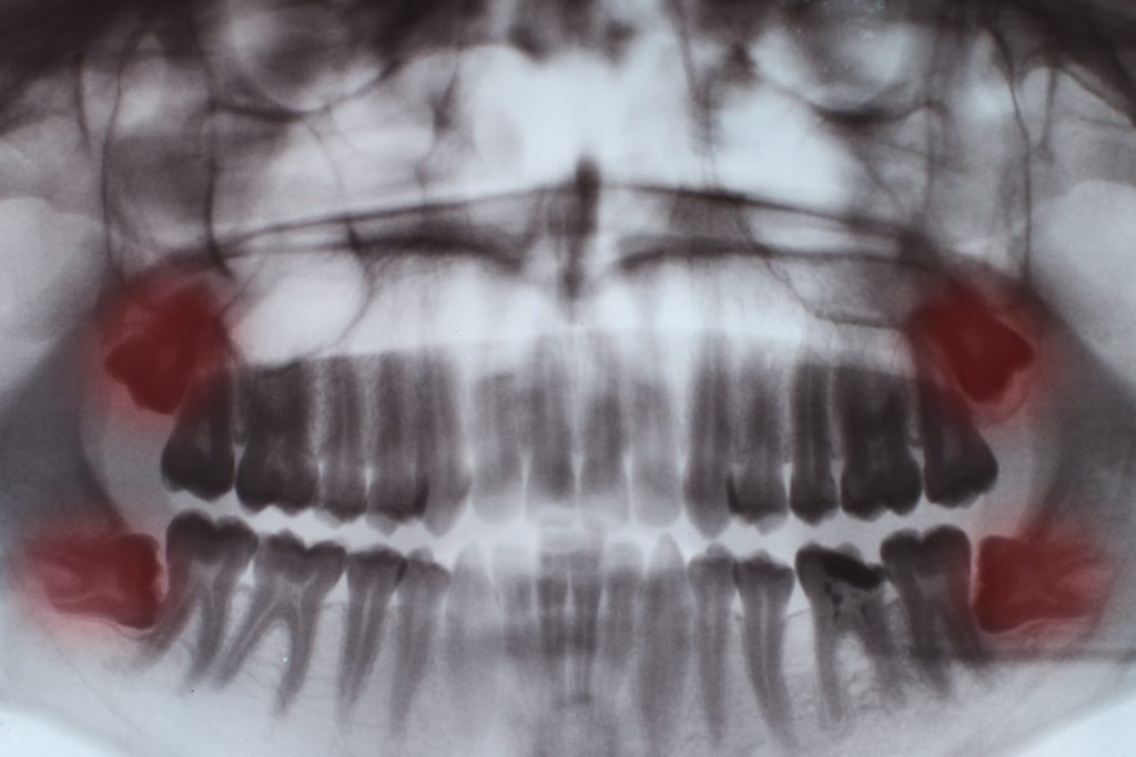 teeth full x ray FUGEHH8 min - Channel Islands Family Dental Office | Dentist In Ventura County