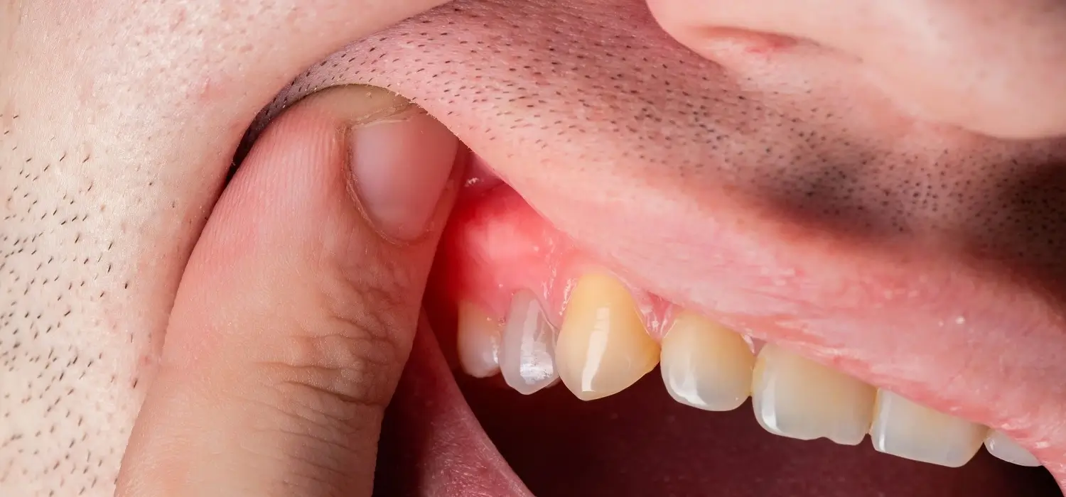 gum-disease