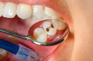 Will Cavities Go Away Naturally or Need a Dentist?
