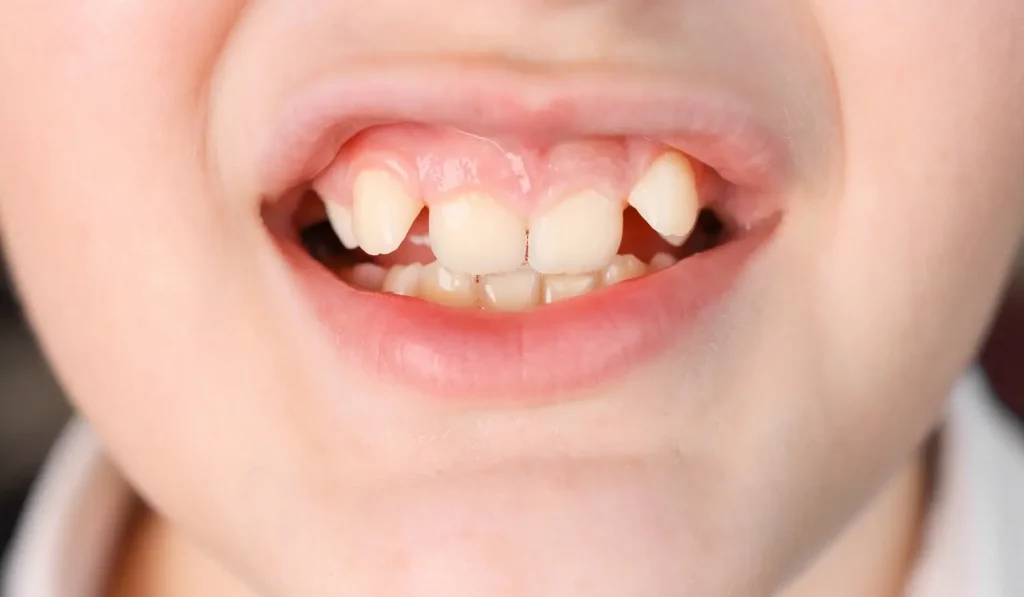 close-up-crooked-teeth-in-babies