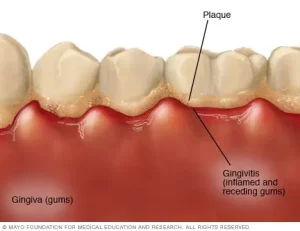different-kinds-of-gingivitis