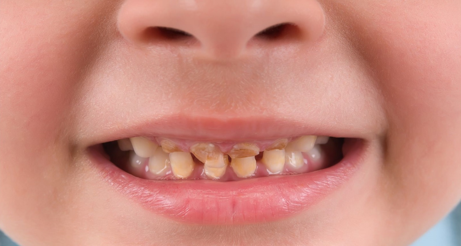 child with dental caries