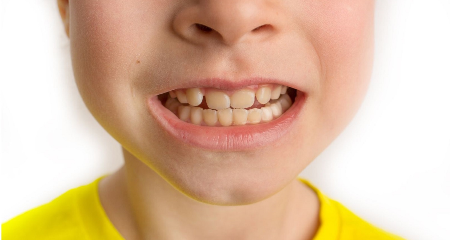 a child with discoloration of teeth