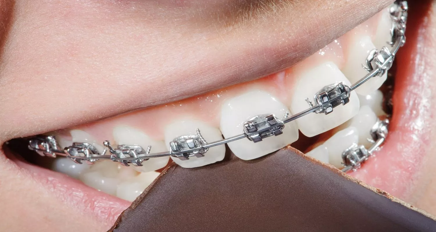 Forcing a bite while having a braces