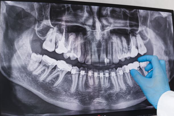 Dental X-Rays vs Panoramic X-rays