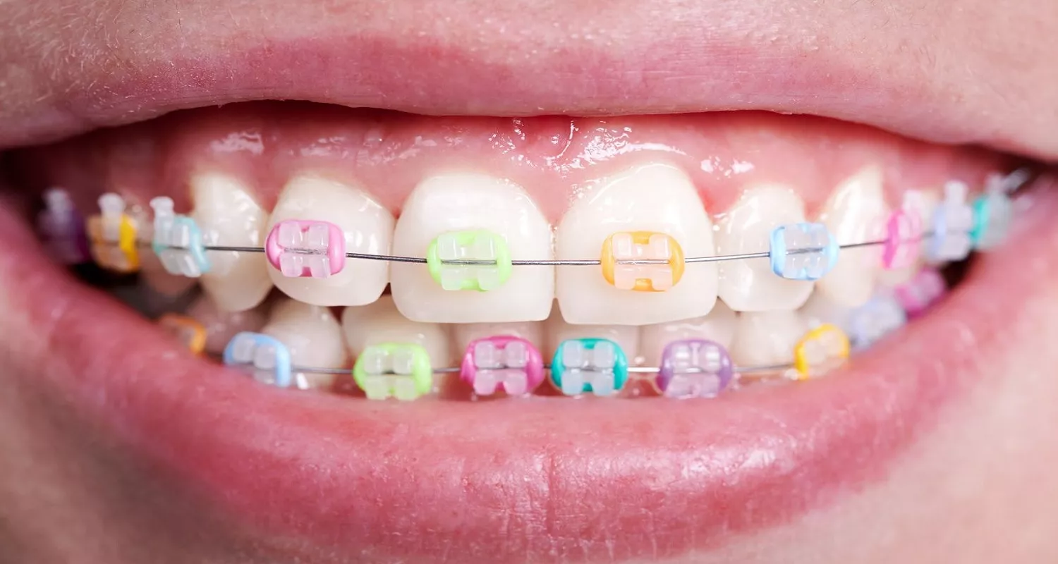 Ceramic braces
