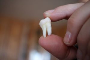 When Wisdom Teeth Need to be Removed?
