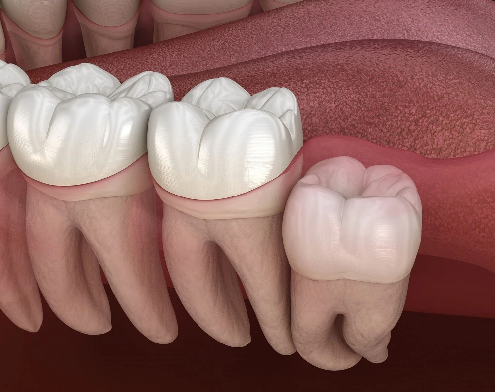 impacted-wisdom-teeth