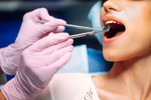 Mujer en revisión dental por caries debajo de las coronas dentales.