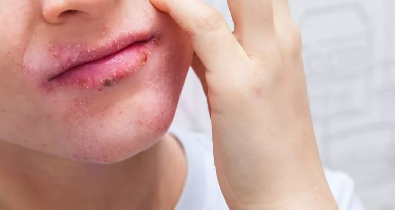 Eczema