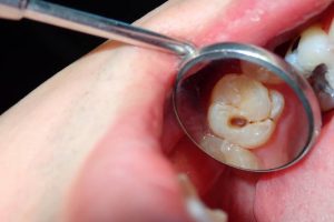 Imagen de referencia de caries debajo de las coronas dentales. 