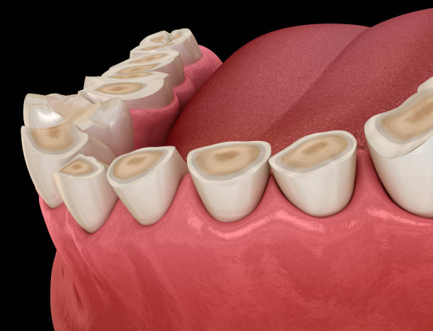 Ilustración de la pérdida de la superficie dura de los dientes