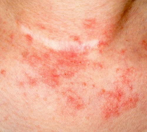 eczema-in-the-skin