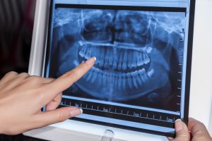 Radiografía dental para poder visualizar las caries debajo de las coronas dentales. 