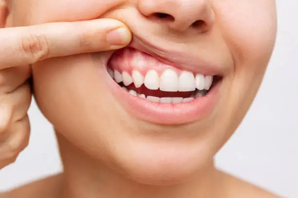 Encía sana - Revertir la periodontitis
