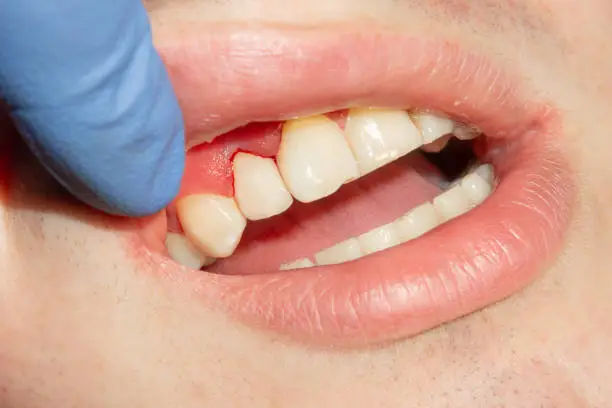 ¿Cómo revertir la periodontitis? Acá te contamos algunos de sus síntomas para que tomes un tratamiento a tiempo.