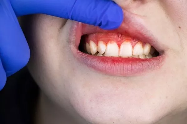 EARLY SIGNS OF GUM DISEASE