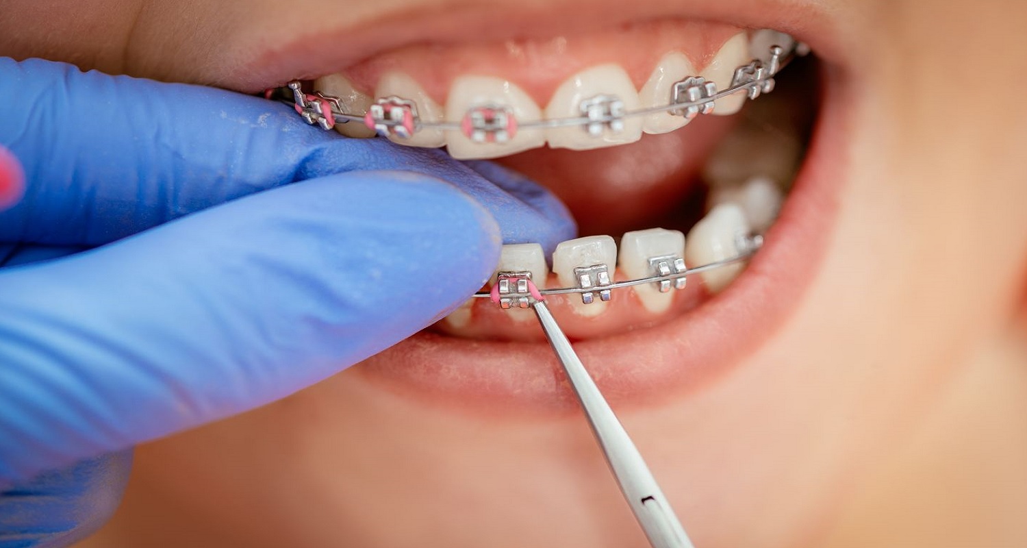 cavities causes by braces