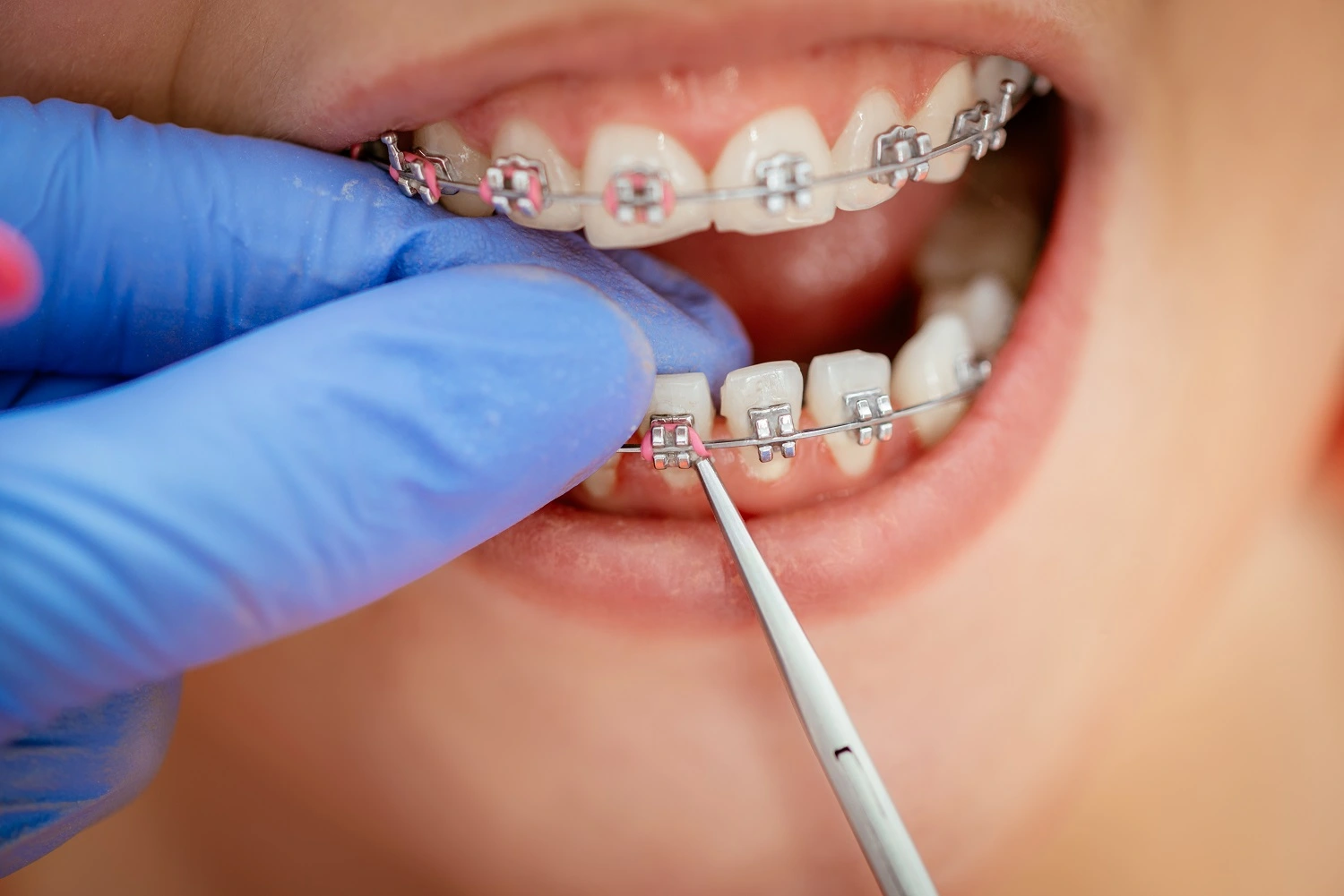 cavities causes by braces