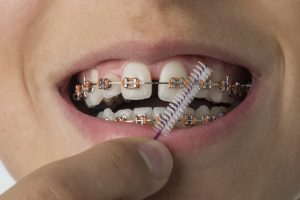 close-up-of-cleaning-dental-braces