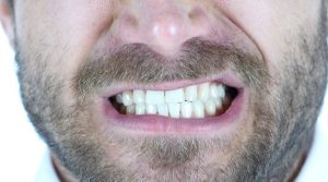 mouth-putting-a-mouthguard