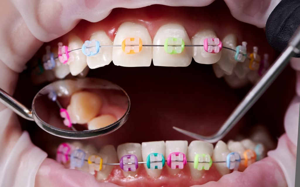 Retiro de ortodoncia. Este procedimiento se puede dar si hay caries causadas por los Brackets. 