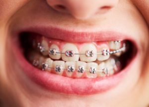 cavities caused by braces