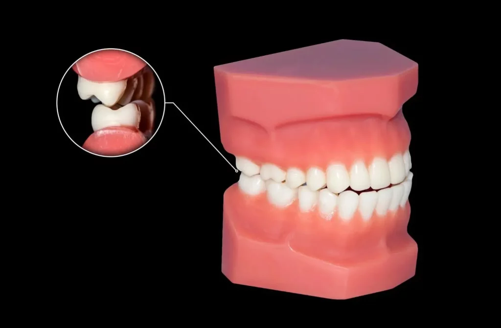 model-of-mouth-showing-the-connection-of-epilepsy-and-teeth-grinding