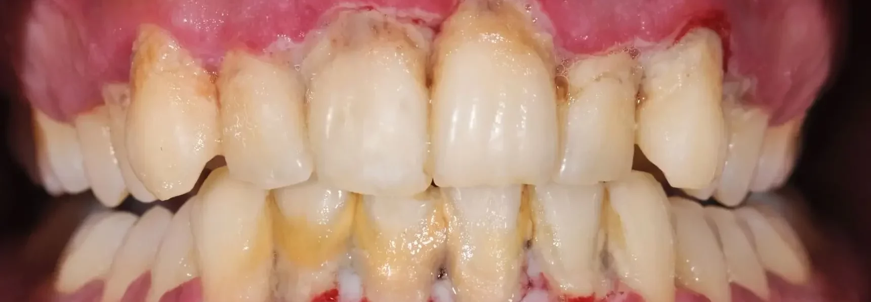 teeth-with-gingivitis