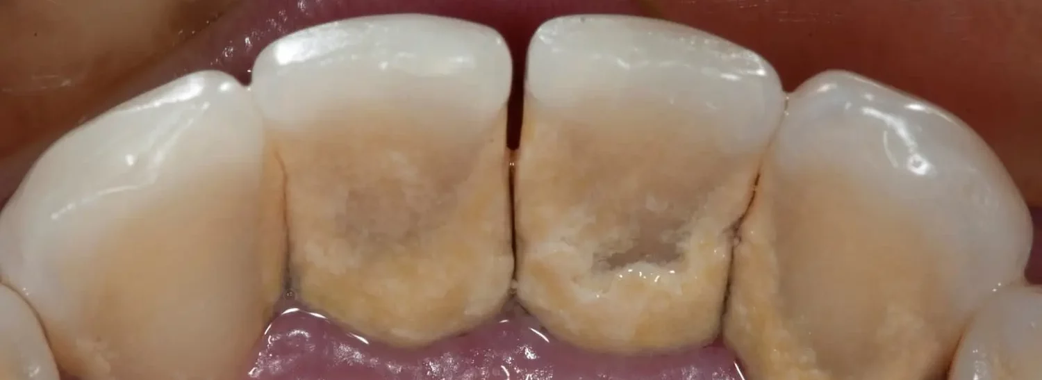 periodontitis-in-the-early-stage-at-the-back-of-teeth
