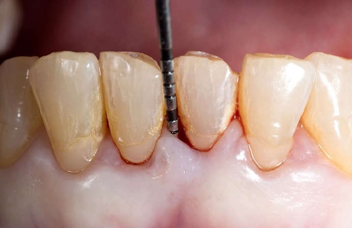 close-up-picture-of-gingivitis