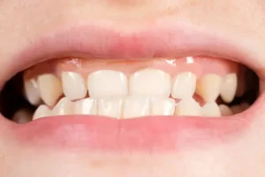 Hiperplasia gingival causada por Nifedipino y la salud dental