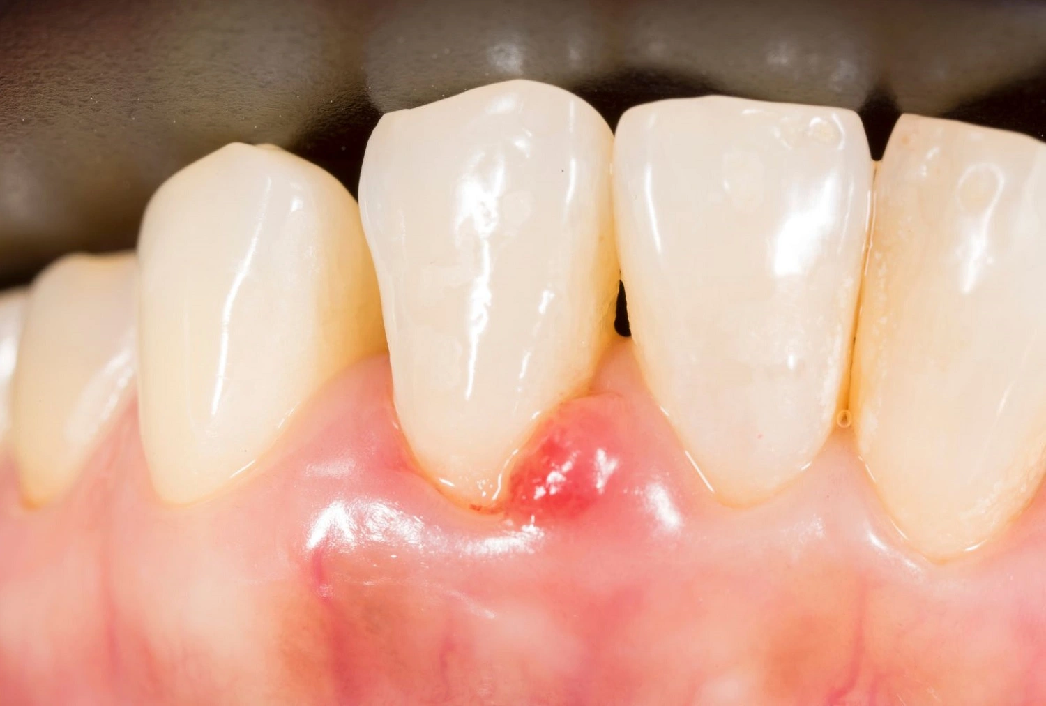 gingival-hyperplasia-from-nifedipine-and-dental-health
