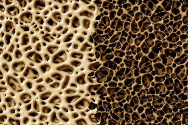 OSTEOPOROSIS & ORAL HEALTH