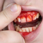 Dental mobility in periodontal disease