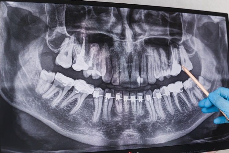 x-ray-of-teeth-with-ankylosed-tooth