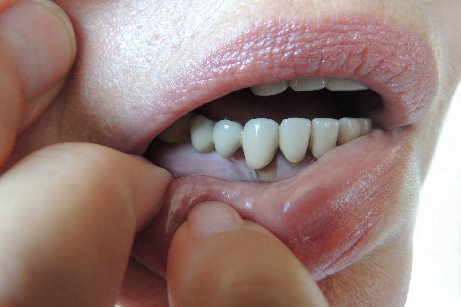 Dental mobility in periodontal disease