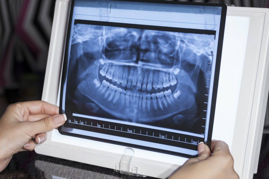panoramic dental x ray - Channel Islands Family Dental Office | Dentist In Ventura County