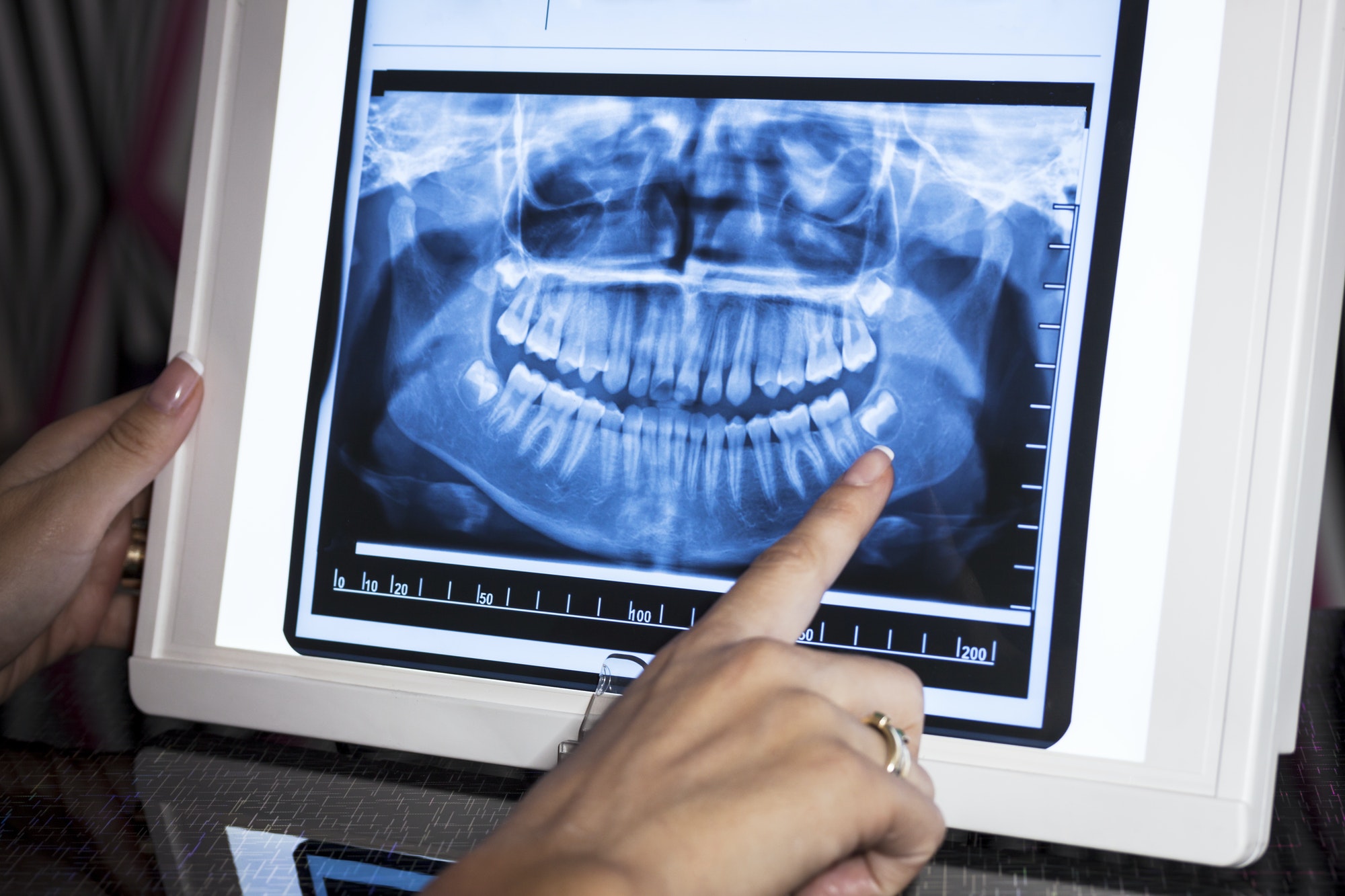 panoramic x ray - Channel Islands Family Dental Office | Dentist In Ventura County