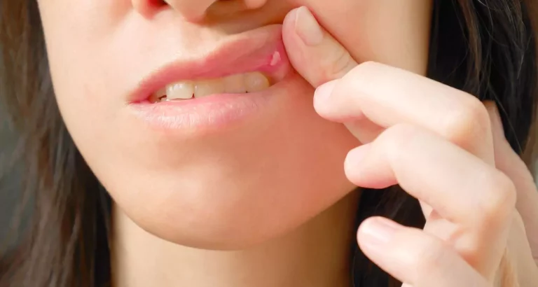 Canker Sores